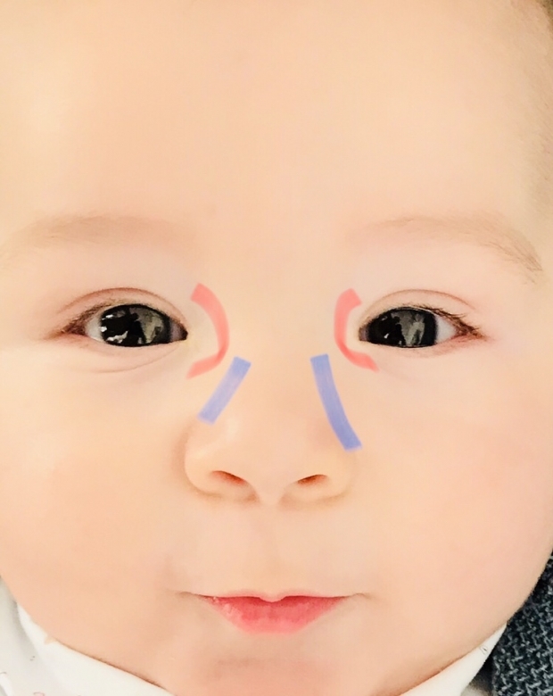 עיסוי דמעות עיניים אצל תינוקות
