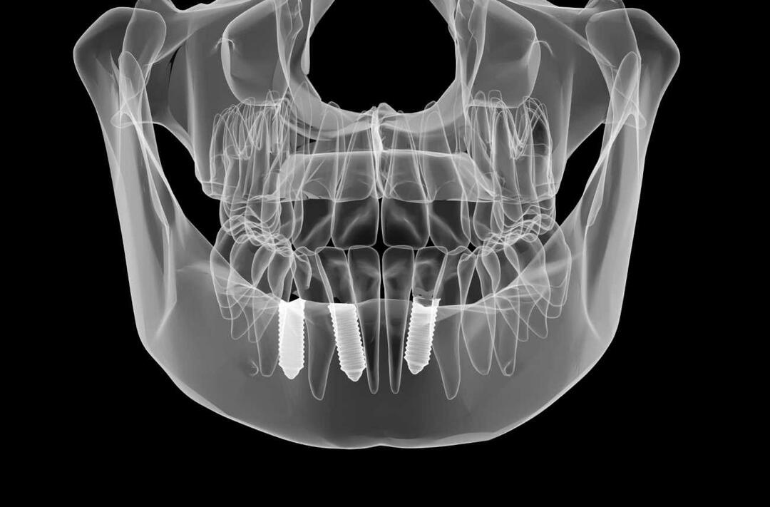 מה עושים לפני ואחרי טיפול השתלת שיניים?