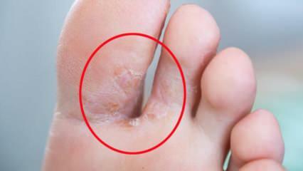 מה זה פטריית כף הרגל? מהם התסמינים של פטרת כף הרגל? האם יש תרופה לכף הרגל של אתלט?