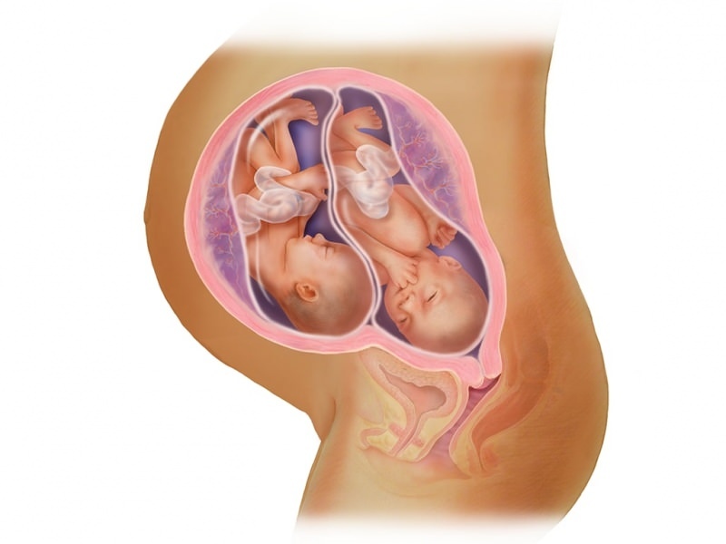 הריון תאומים ב- IVF! מה זה העברת עוברים?