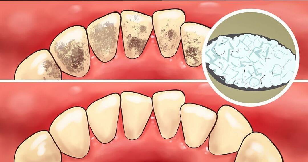 גורמים להיווצרות אבנים בשיניים
