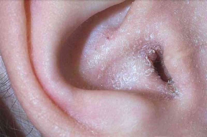 מה גורם לקילוף מאחורי האוזן ואיך זה עובר? הפיתרון המובהק לאקזמה מאחורי האוזן ...