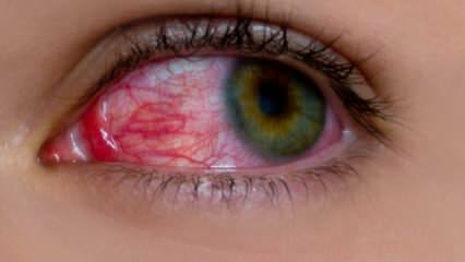 מה גורם לאלרגיה לעיניים? מהם התסמינים של אלרגיה לעיניים? מה טוב לאלרגיות עיניים? 