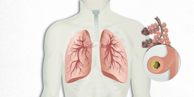 הנגיף שמתיישב בריאות מעורבב בדלקת ריאות