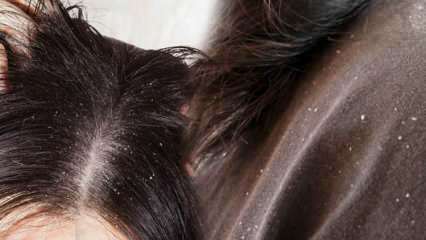 איך חולף קשקשים ומה טוב לשיער קשקשים? 5 שיטות מהירות ויעילות ביותר להסרת קשקשים