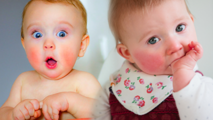 תשומת לב אצל תינוקות עם לחיים אדומות! תסמונת לחי סטירה ותסמיניה