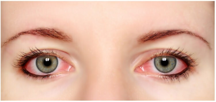 האם מסקרה ואייליינר אלרגית בעיניים?