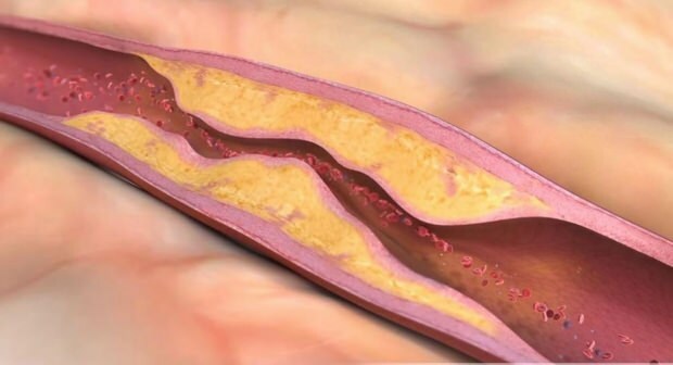 מה גורם לטרשת עורקים? כמה סוגים של סתימת כלי דם יש?