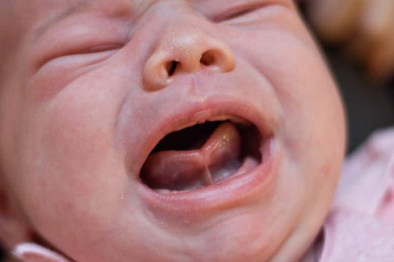 מהו קשר שפה? ניתוק לשון אצל תינוקות