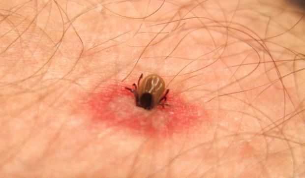 איזו עקיצת חרקים איך? תסמינים של עקיצות חרקים! שיטה טבעית לעקיצות יתושים