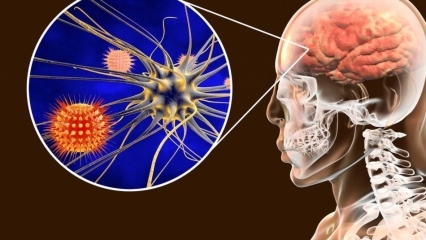 מהי דלקת קרום המוח ומה הסימפטומים? האם יש טיפול בדלקת קרום המוח?
