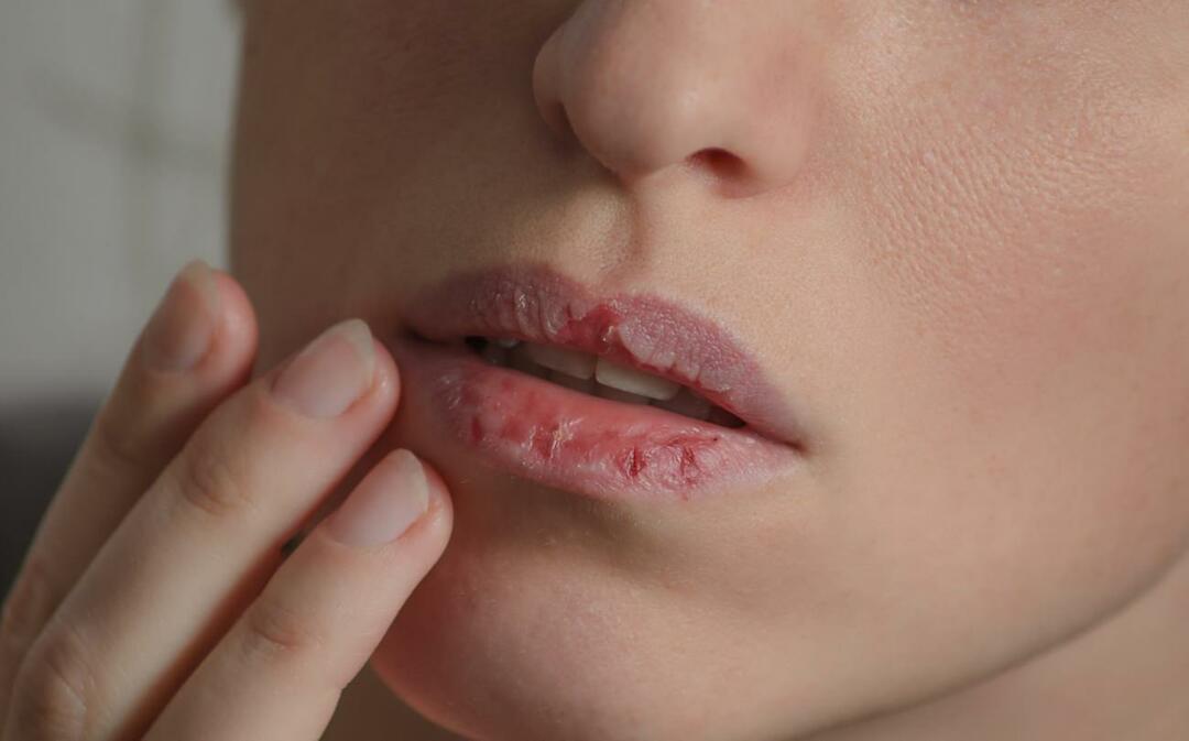 מה גורם לשפתיים כהות? כיצד מטפלים בהכהות שפתיים או בחבלות?