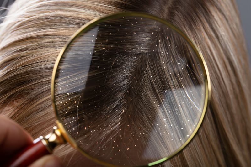 איך חולף קשקשים ומה טוב לשיער קשקשים? 5 סעדי הקשקשים המהירים והיעילים ביותר