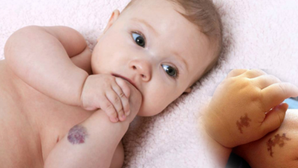 גורם לכת לידה אצל תינוקות, האם זה קבוע? מהם סוגי כתמי הלידה? תרופה מסראקוגלו