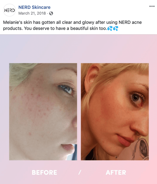דוגמה לאופן שבו Nerd Skincare השתמשו בתמונה לפני ואחרי כדי ליצור פוסט תמונה עבור מדיה חברתית שמניעה רכישות של המוצרים שלהם.