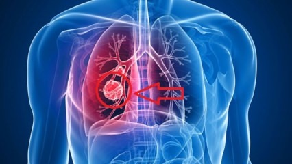 תסמינים של סרטן ריאות: שלבים של סרטן ריאות!