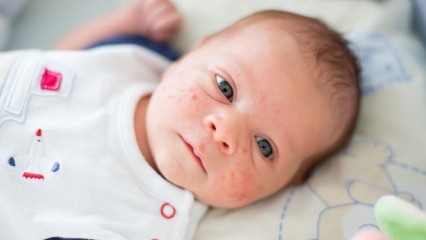 איך עוברות פצעונים על פני התינוק? שיטות ייבוש אקנה (מיליה)