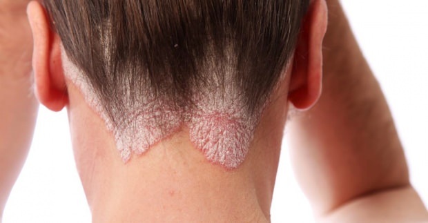 תסמינים וטיפול בדלקת עור סבוראית