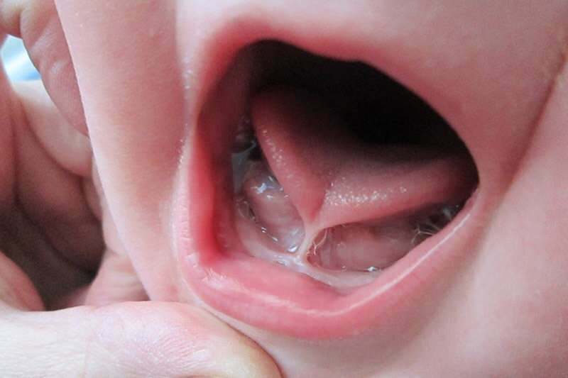 תסמינים וטיפול בקשירת לשון אצל תינוקות