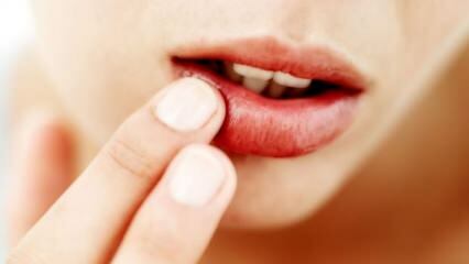מה טוב לפיצוח שפתיים?