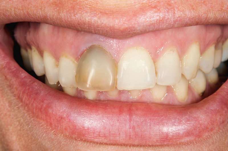 התכהות שיניים יכולה להתרכז לפעמים בשן אחת
