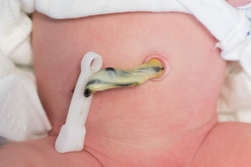 מתי נחתך חבל הטבור בתינוקות? היתרונות של חיתוך חבל הטבור באיחור