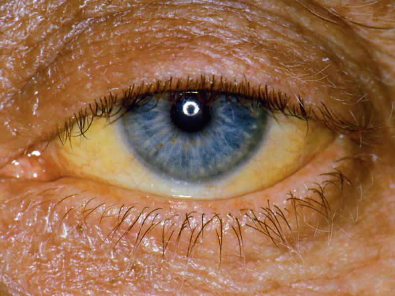גובה ברמת הבילירובין גורם לצבע צהוב על העיניים והעור