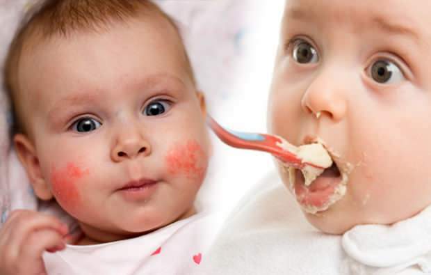 תסמיני אלרגיה אצל תינוקות