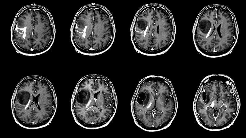 מה גורם לגידול במוח? מהם התסמינים של גידול במוח? האם הטיפול בגידול במוח קשה?