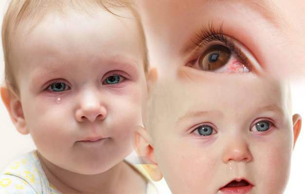 גורם לדימום בעיניים אצל תינוקות