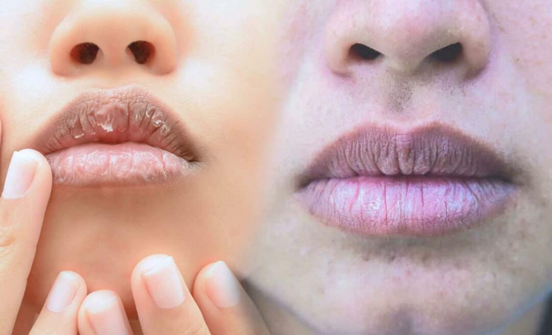 מה גורם לשפתיים כהות? כיצד מטפלים בהכהות שפתיים או בחבלות?