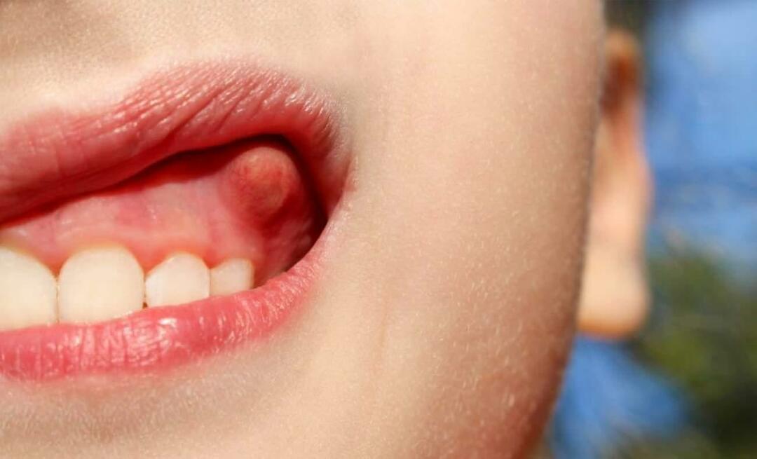 מדוע מורסה השן ומהם התסמינים? מורסה דנטלית, איך מטפלים בה?