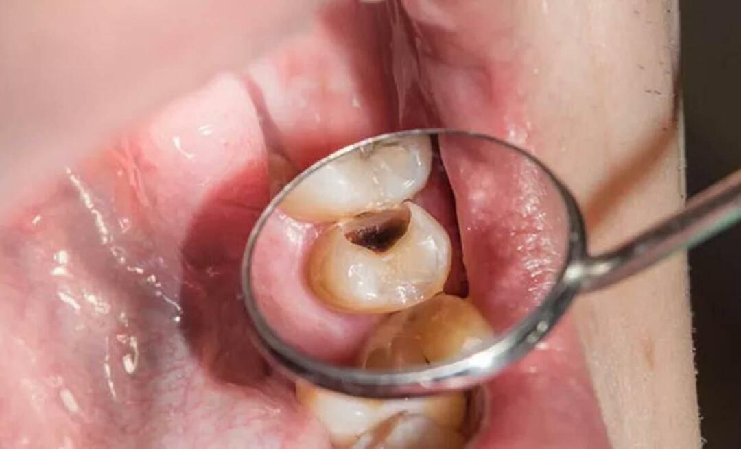 מדוע שיניים נרקבות ומה ניתן לעשות כדי למנוע זאת? 