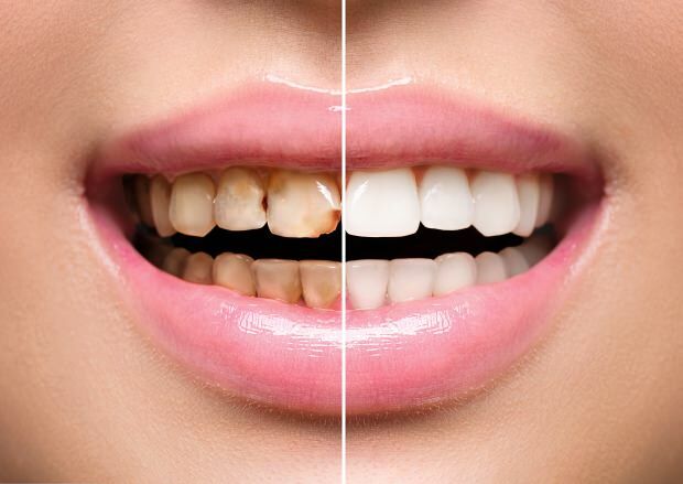 כתוצאה מתזונה לא בריאה, מתרחשים גם שינוי צבע בשיניים וגם אובדן שיניים