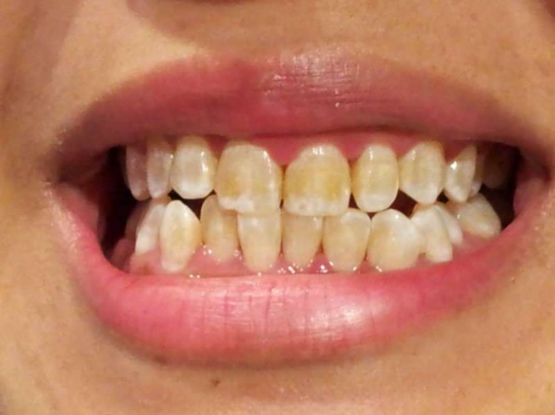 תמונת שיניים של אדם ששיניו מתחילות להחשיך