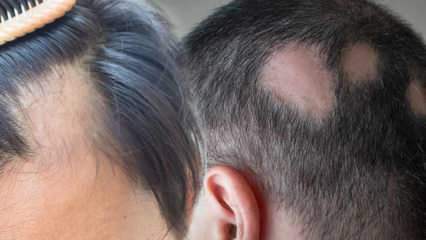 מהי גזזת (Alopecia areata)? מהם תסמיני גזזת? פתרונות יעילים לגזזת