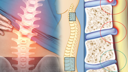 מהי צמצום חוט השדרה? מהם התסמינים של היצרות חוט השדרה? האם יש תרופה להצרת חוט השדרה?
