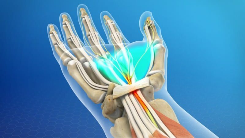 כתוצאה מלחץ, נפגעת מערכת השרירים של פרק כף היד הגורמת לתסמונת התעלה הקרפלית