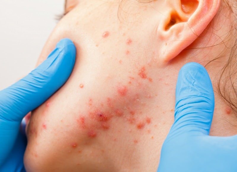 הנגיף גורם לשלפוחיות על פני העור