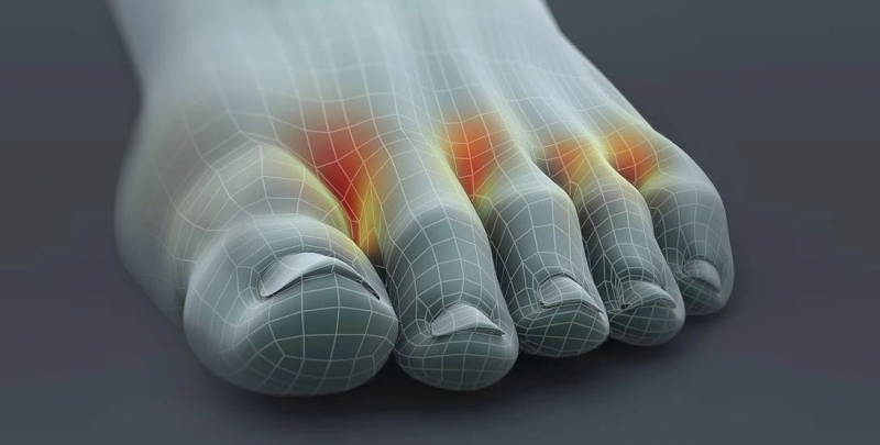 פטריית כף הרגל הנפוצה ביותר היא בין אצבעות הרגליים