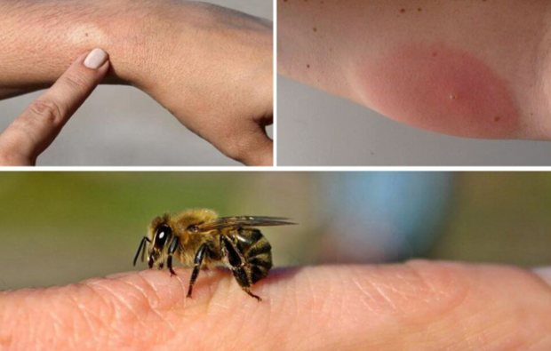 תסמיני אלרגיה לדבורים