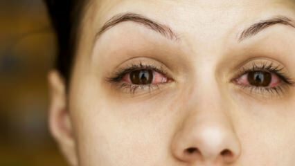 מהי דלקת הלחמית (שפעת עיניים) ומה הסימפטומים? כיצד מועבר דלקת הלחמית?